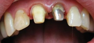 Photo: Dents préparées pour la fixation des cermets