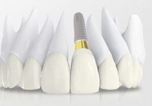 Photo: implantation de dentium