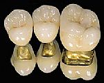 Photo: couronnes en céramique-métal sur un cadre en or pour mâcher des dents