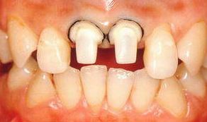 Photo: Dents tournant avec un rebord