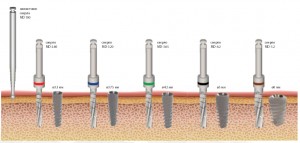 Photo: Variétés d'implants
