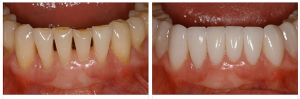 Photo: Avant et après restauration dentaire avec facettes