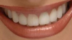 Photo: facettes en céramique sur les dents de devant