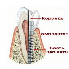 Photo: Structure de l'implant