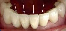 Photo: facettes sur les dents inférieures