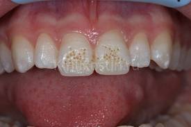 Photo: La présence de taches sur les dents de devant