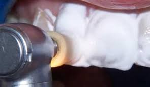 Photo: Nettoyage de la surface des dents avant la restauration