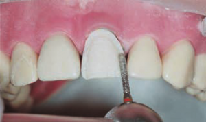 Photo: Préparation d'une dent pour le placage