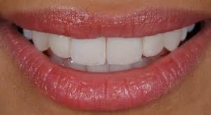 Photo: Dents après restauration avec des facettes