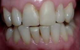 facettes pour dents inférieures do1