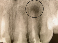 Photo: kyste de la racine d'une dent aux rayons X