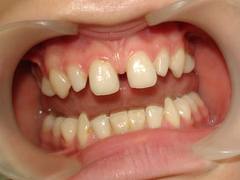 Photo: La présence d'écarts entre les dents