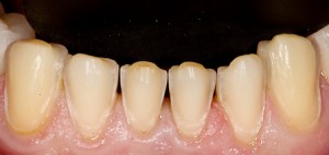Photo: Dents inférieures après la préparation des facettes