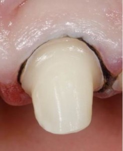 Photo: Un fil entre une dent et une gencive pour faire bonne impression