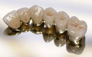 Photo: couronnes dentaires en céramique-métal