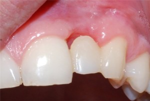 Photo: Prothèse provisoire de la dent supérieure