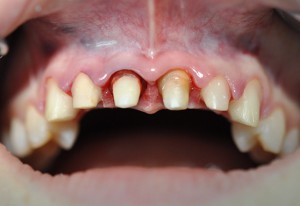 Photo: dents tournées sur des couronnes en zirconium