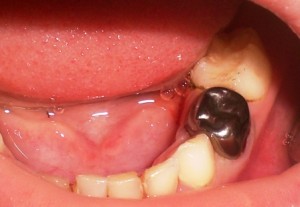 Photo: Une couronne métallique montée sur une dent à mâcher