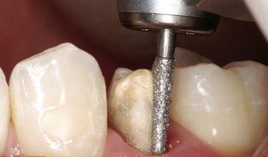 Photo: Préparation des dents
