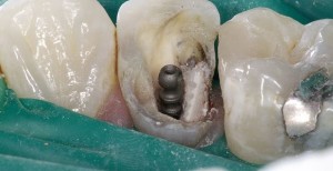 Photo: Restauration des dents avec une épingle