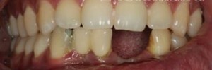 Photo: Restauration des dents de la mâchoire inférieure par cermet