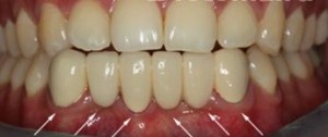 Photo: Restauration des dents de la mâchoire inférieure par cermet après