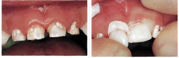 Photo: Restauration des dents avec des couronnes en bande
