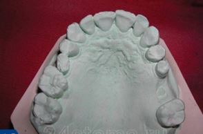 Photo: modèle en plâtre de dents