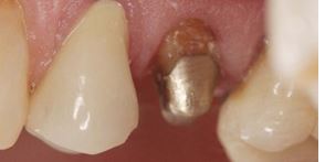 photo: dent restaurée par la languette du moignon