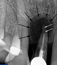 Photo: kyste dentaire sous la couronne sur la radiographie