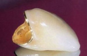 Photo: couronne dentaire Cermet