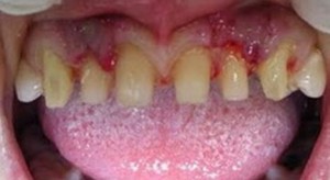 dents aiguisées pour couronnes permanentes