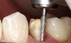Photo: rotation des dents