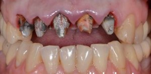 Photo: dents cariées sous les couronnes