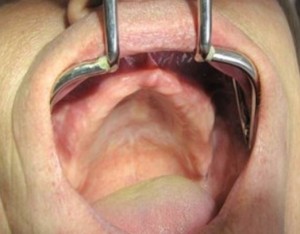 absence complète de dents dans la mâchoire supérieure