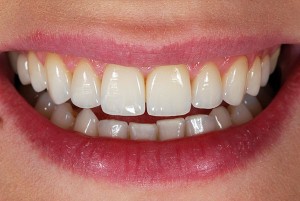 Photo: couronnes en zirconium sur les dents de devant