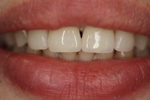 Photo: Prothèses des dents de devant avec des céramiques non métalliques