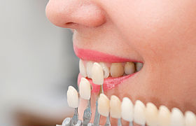 Photo: Détermination de la couleur des dents