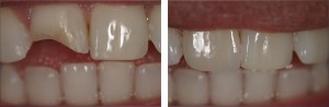 Photo: Avant et après restauration dentaire avec placage