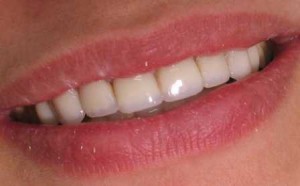 Photo: Dents après restauration esthétique