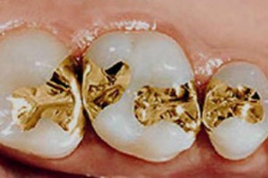 Photo: Restauration des dents avec des incrustations métalliques