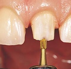 Photo: Préparer une dent pour la restauration