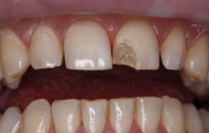 Photo: Destruction de la dent avant - une indication pour la restauration esthétique