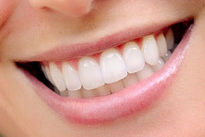 Photo: Après restauration des dents avec des facettes