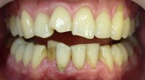 Photo: Dents ébréchées et dentition