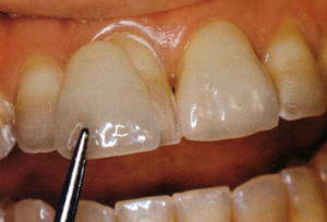 Photo: Installation de facettes lors du changement de couleur des dents