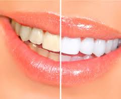 Photo: Dents avant et après restauration esthétique