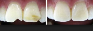 Photo: Avant et après restauration des dents de devant ébréchées