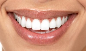 Photo: Dents après restauration des facettes