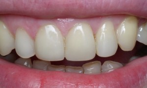Photo: Dents après restauration avec des photopolymères